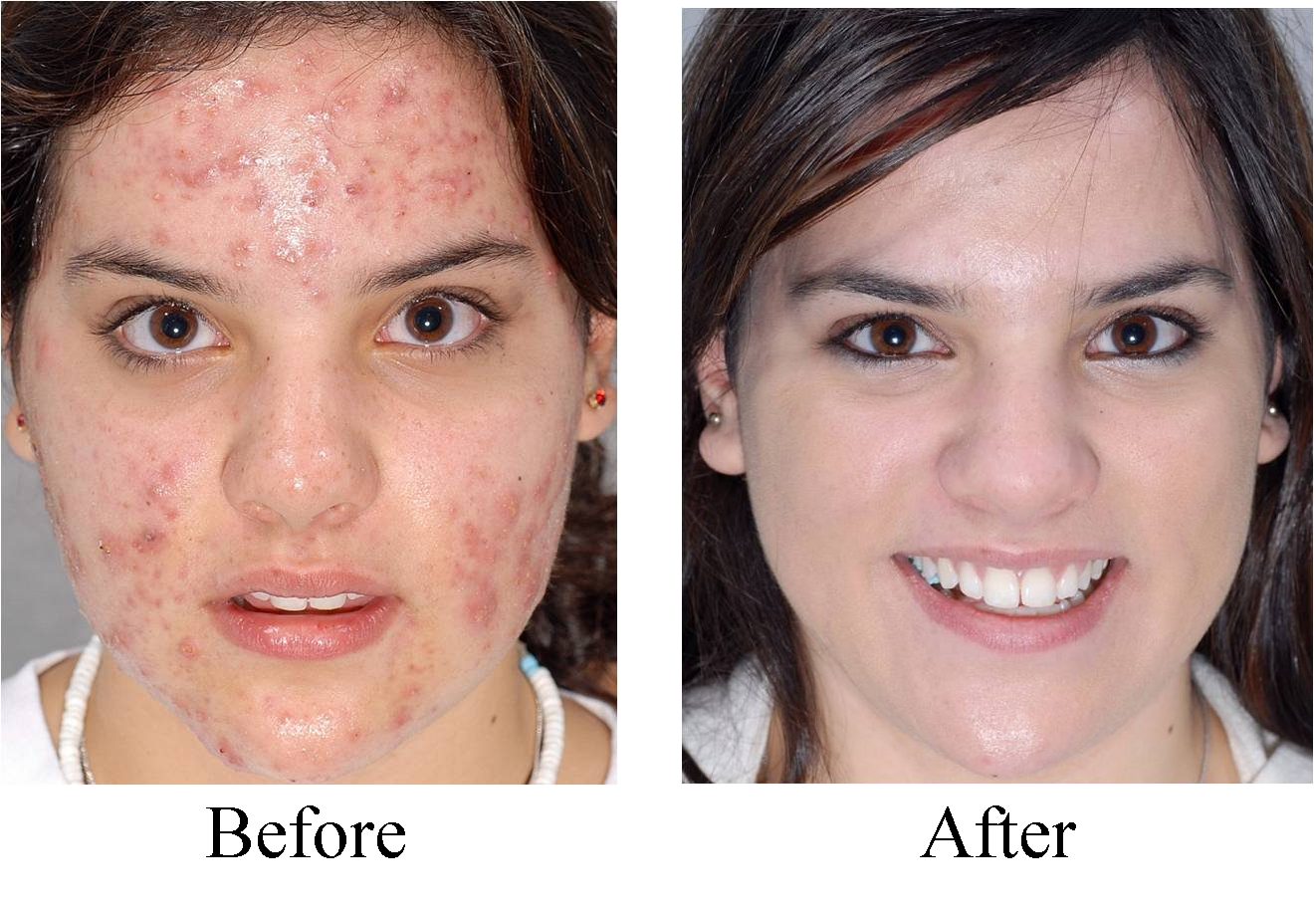 Acne Before and After'