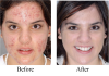 Acne Before and After'