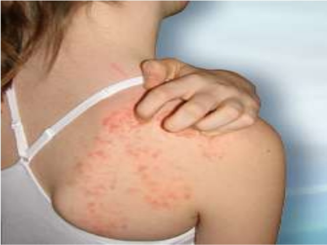 OxyHives'