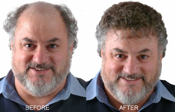 Provillus Hair loss'