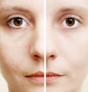 Revitol Scar Cream'