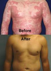 Revitol Dermasis Psoriasis Treatment - Before and After'