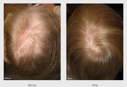 Provillus Hair Loss'