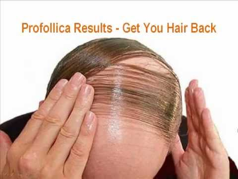 Profollica Hair Loss Solution'