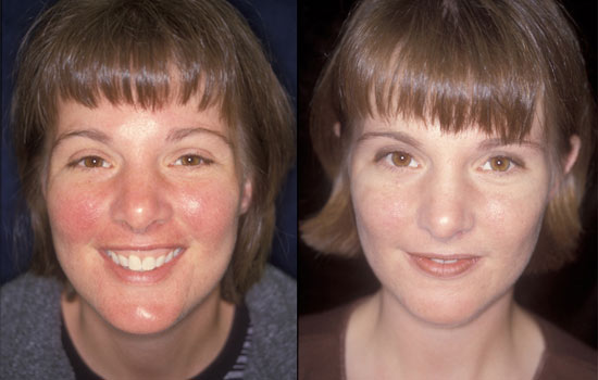 Revitol Rosacea Cream'