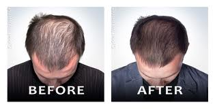 Harvokse Hair Regrowth'