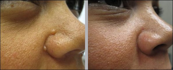 Revitol Skin Tag Removal'