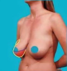 BreastLiftSimply.com'