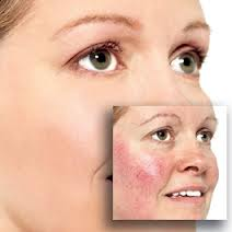 Revitol Rosacea Cream'