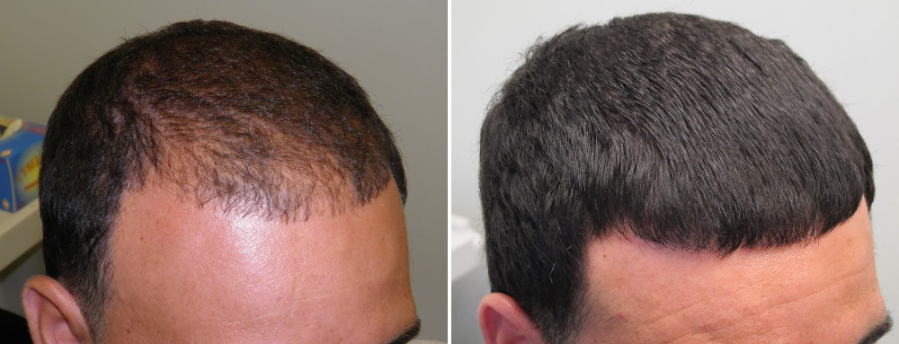 Provillus Hair Loss'