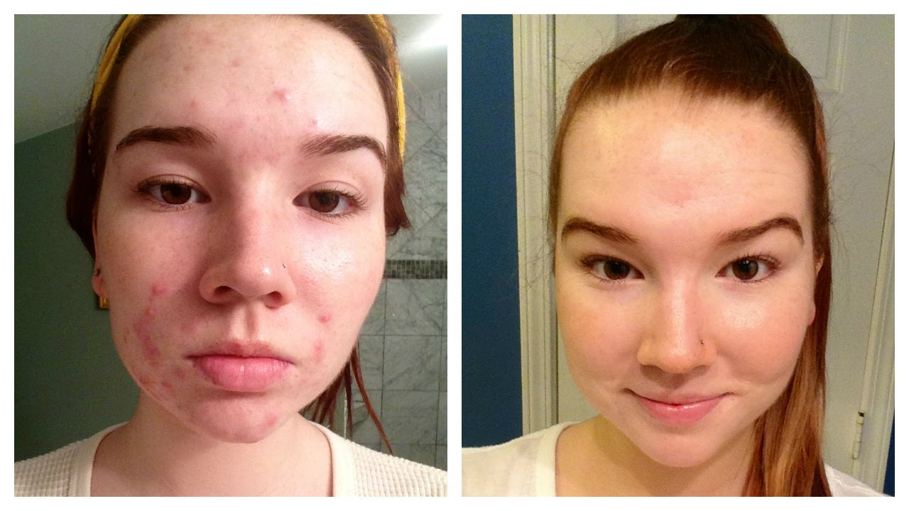 Clearpores Acne Cream'
