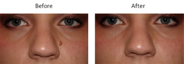 Revitol Skin Tag Removal'