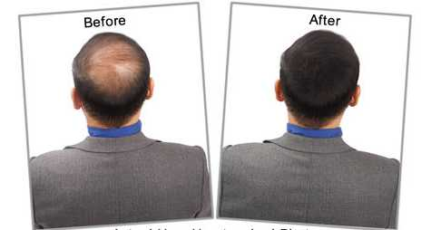 Provillus Hair Loss'
