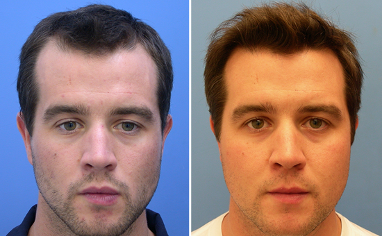 Profollica Hair Loss'