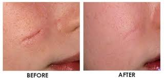 Revitol Scar Cream'