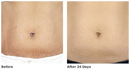 Revitol Stretch Marks Cream'