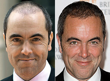 Profollica Hair Loss'