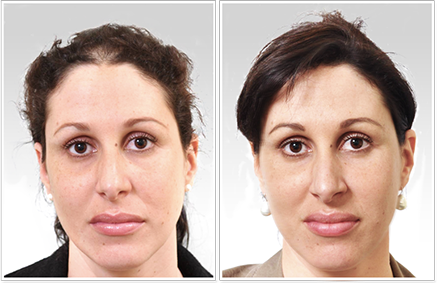 Provillus Hair Loss'