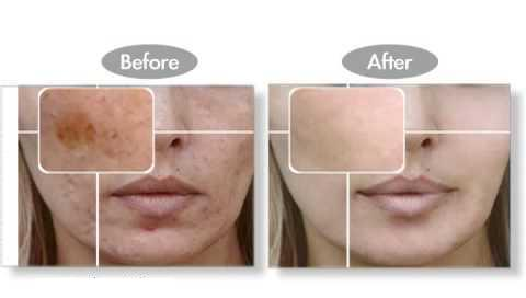 Revitol skin brightener'
