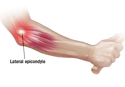 Tennis Elbow Pain Relief'