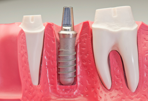 Dental Implants by Dr. Timm