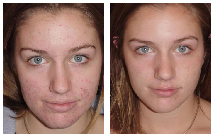 Clearpores Acne Cream'