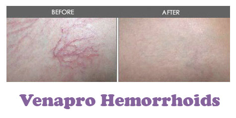 Venapro Hemorrhoids Solution'