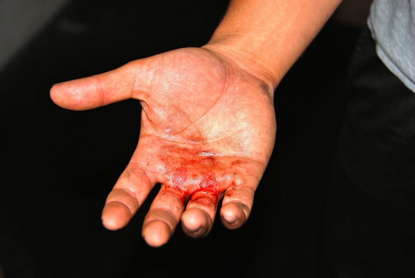 Blister Hand Repiar'