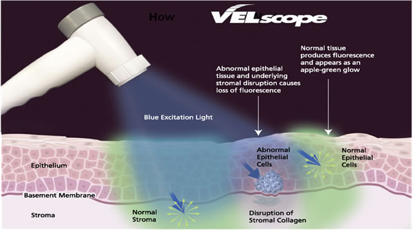 VELscope