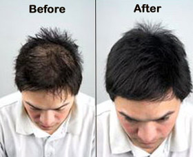 Provillus Hair Loss'