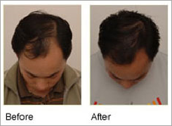 Profollica Hair Loss'