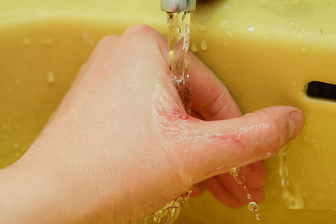 Cooking Injury Burn Pain Cream'