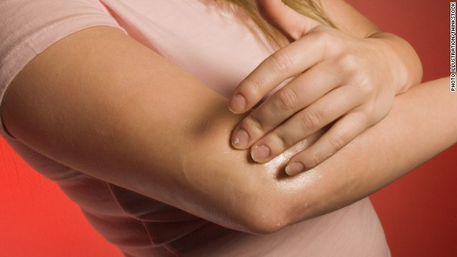 Cooking Injury Burn Pain Cream'