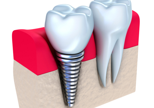 Dental Implants by Dr. Kelly LeBlanc