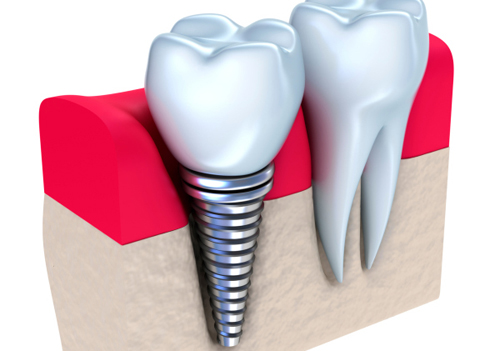 Dental Implants by Dr. Kelly LeBlanc'