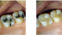 Amalgam Filling'