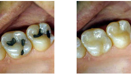 Amalgam Filling