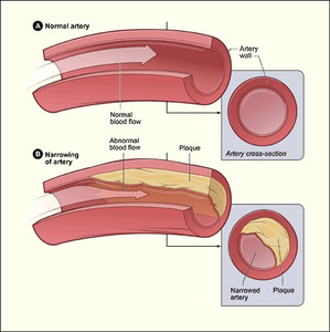 Periodontal Disease'