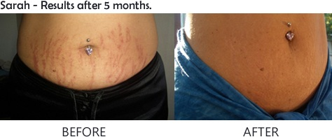 Revitol Stretch Marks Cream'