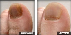 ZetaClear Nail Fungus'