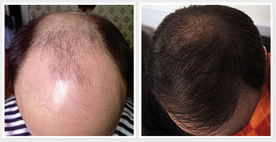 Provillus Hair Loss Solution'