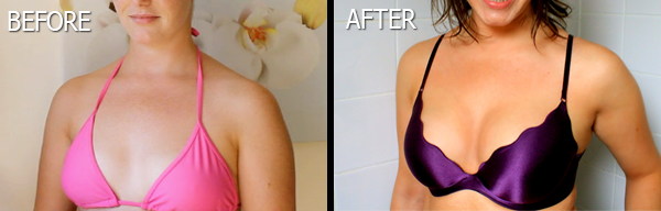 Brestrogen Before And After'