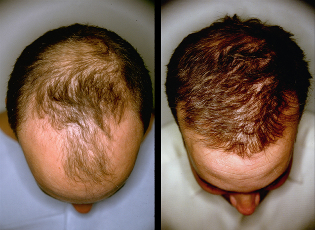 Provillus Hair Loss'