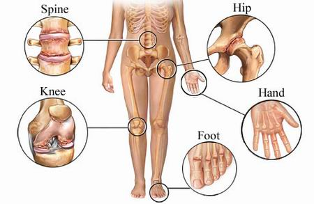 Arthritis points that needs to be relieved'