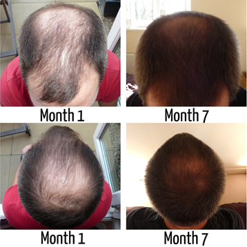 Hair Loss Solution'