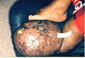 lymphedema