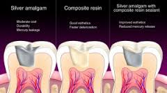 dental amalgam