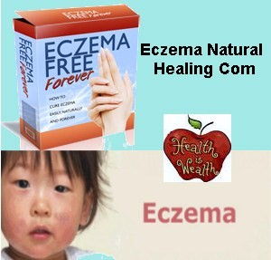 Eczema Natural Healing'