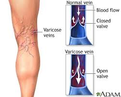 varicose veins