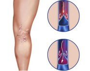 varicose vein